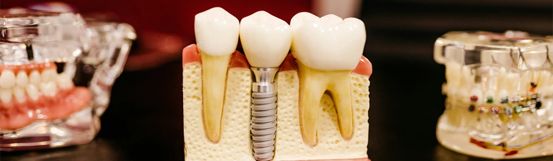 Dentist-Phoenix-AZ-Dental-Implants-Hero.webp Dentist-Phoenix-AZ-Dental-Implants-Hero.webp